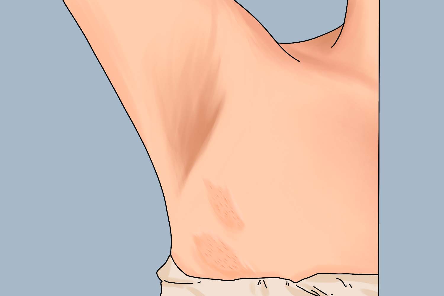 荨麻疹腋下橘皮症状图