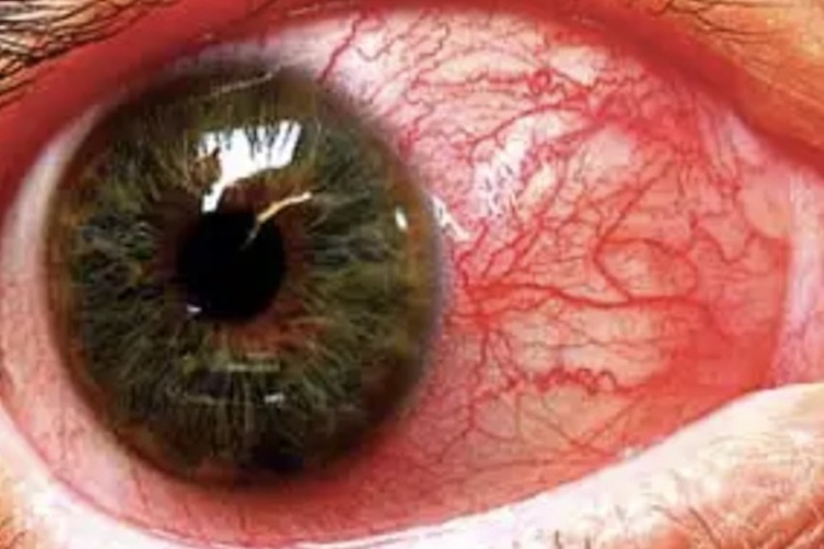 虹膜炎图