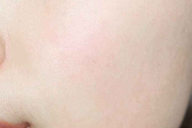 正常人皮肤状态图