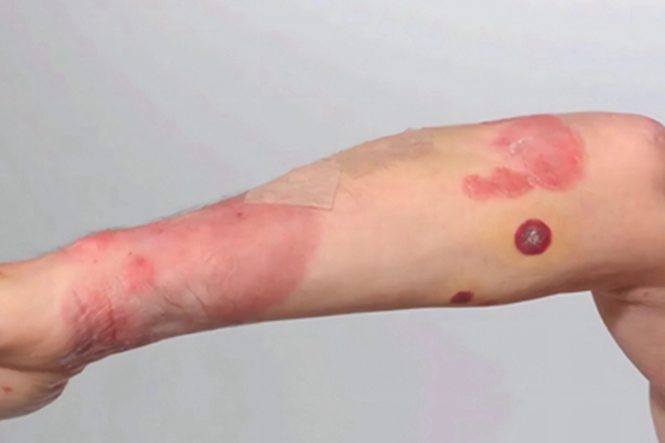 蕈样肉芽肿胳膊肿块图 蕈样肉芽肿胳膊肿块图