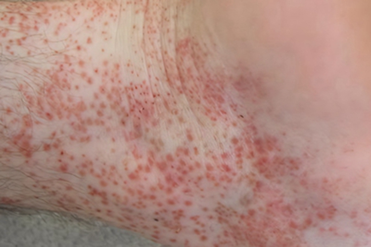 光泽苔藓脚踝长小红点图