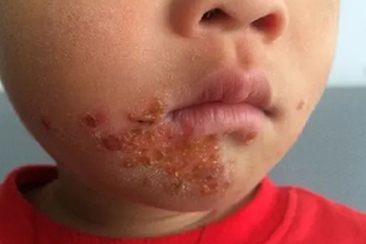 脓疱病面部黄痂图