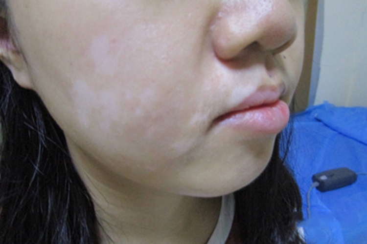 面肢端型白癜风面部症状图 面肢端型白癜风面部症状图