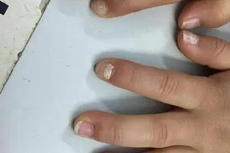 脱甲病手指甲裂纹图