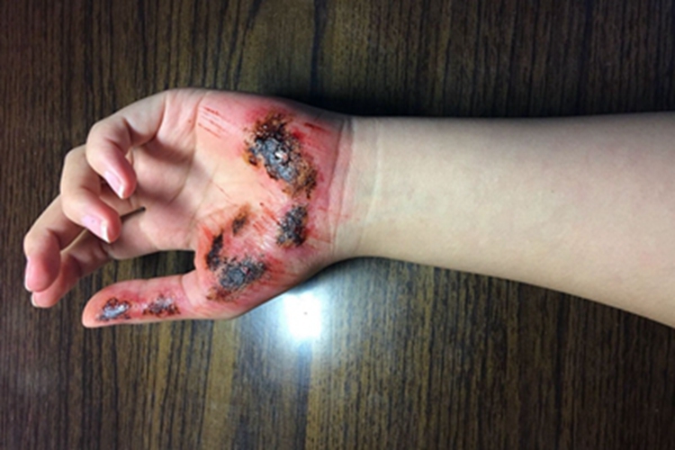 磨压伤手掌血痂图