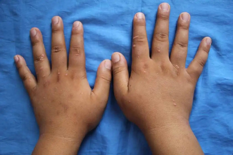 儿童感染HPV扁平疣图