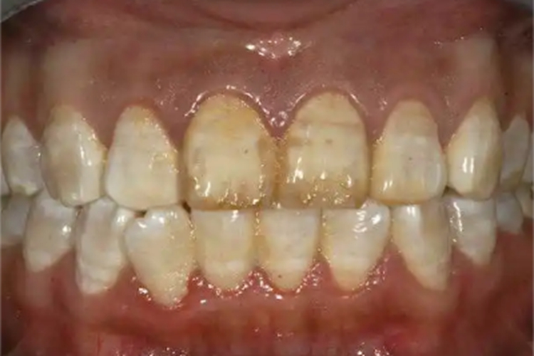 氟骨症牙齿长斑和凹坑图 氟骨症牙齿长斑和凹坑图