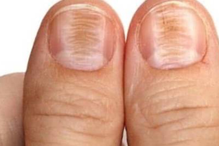 营养缺乏导致手指甲波浪纹图