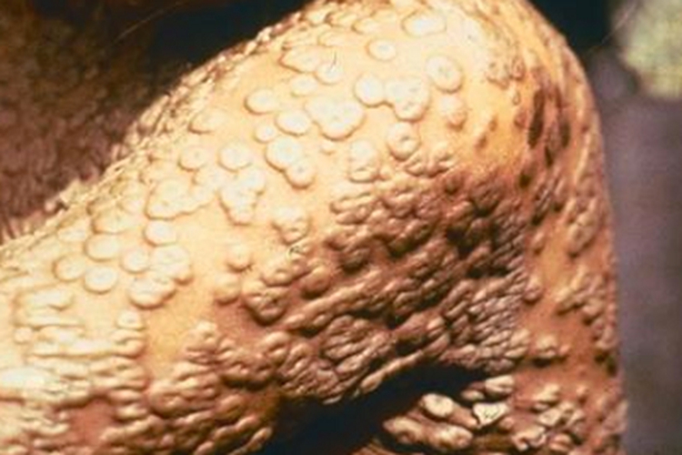 天花胳膊布满小圆疙瘩图 天花胳膊布满小圆疙瘩图