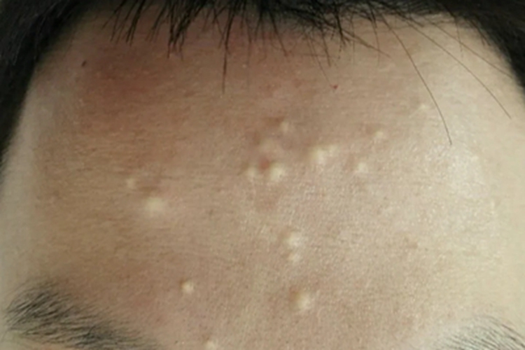 多发性皮脂腺囊肿前额疙瘩图