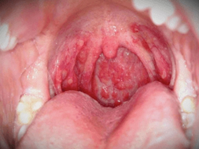 脓毒型猩红热咽喉部有明显的红肿疙瘩图.jpg