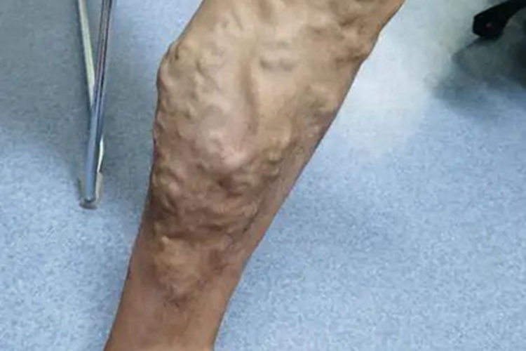 游走性血栓性静脉炎小腿肿物图