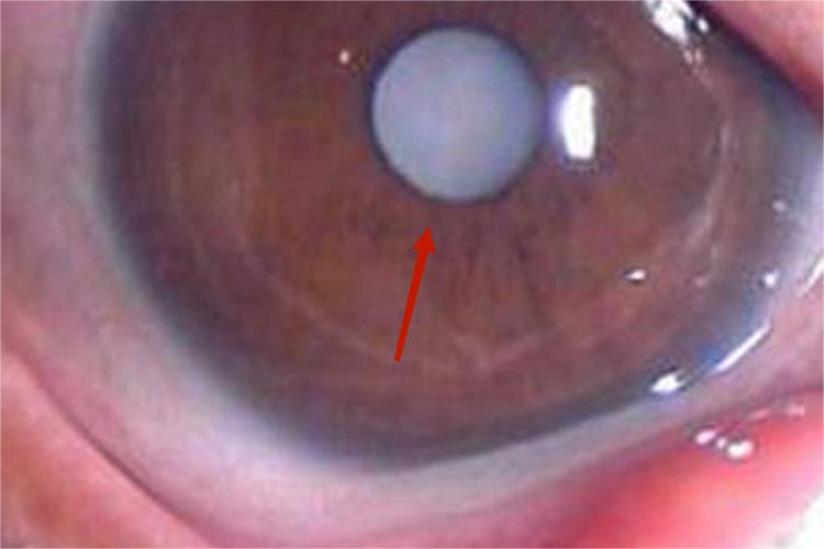 核性白内障白点图