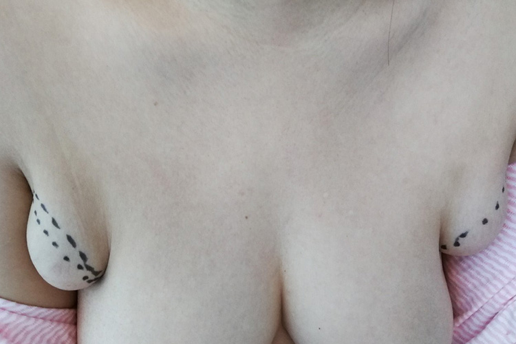 不完全性副乳图片