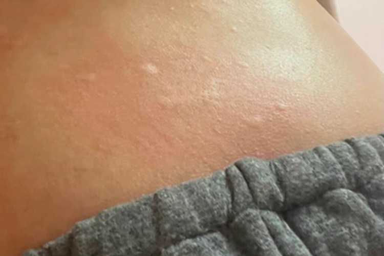 荨麻疹腰部疙瘩图 荨麻疹腰部疙瘩图