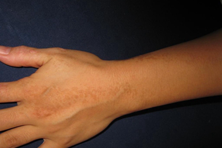 炎症型表皮痣手背症状图