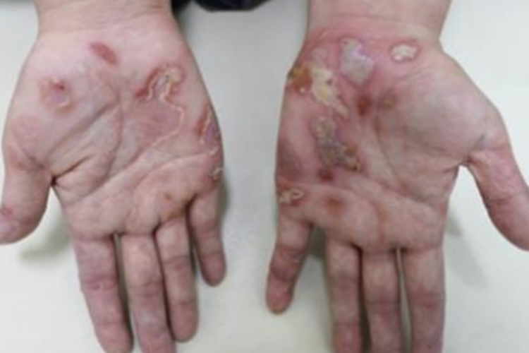 急性发热性嗜中性皮病手掌脱屑图