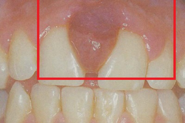 慢性龈炎牙龈肿肉球图