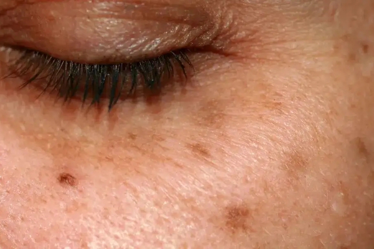 光老化眼周纹图