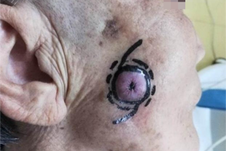 结节型基底细胞瘤面部圆疙瘩图