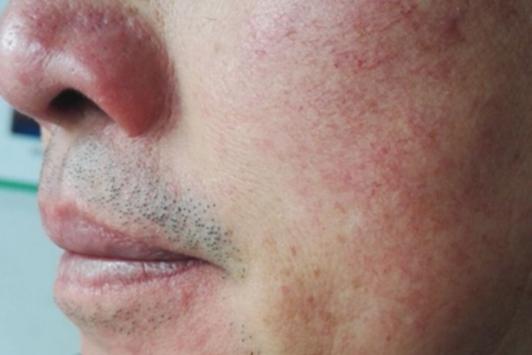 红斑毛细血管扩张型酒糟鼻症状图 红斑毛细血管扩张型酒糟鼻症状图