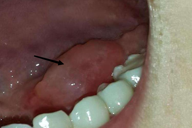 舌下腺炎舌下腺一侧肿大图