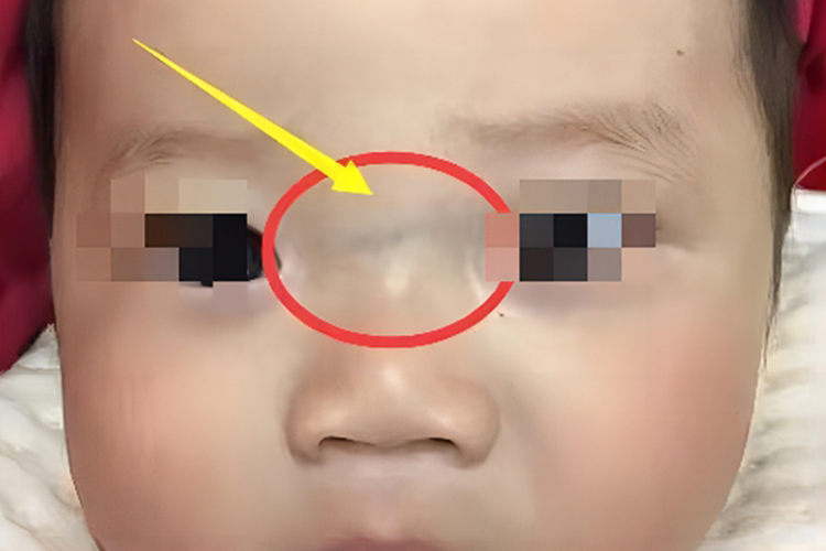 儿童积食鼻梁青筋图