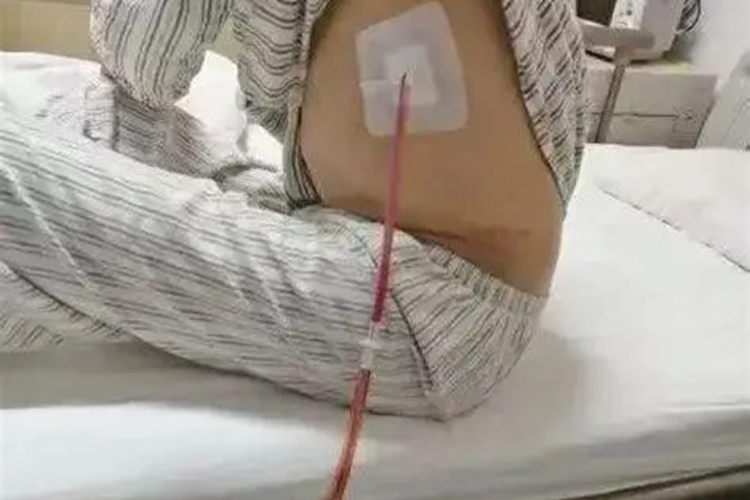 气胸引流位置图