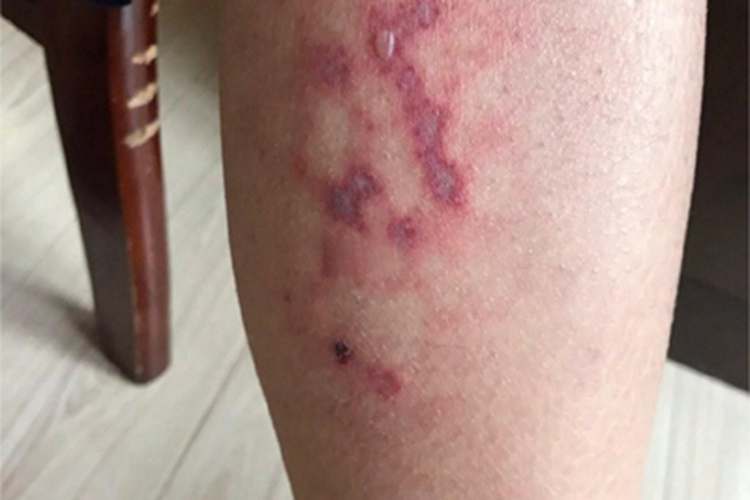 火激红斑长水疱图