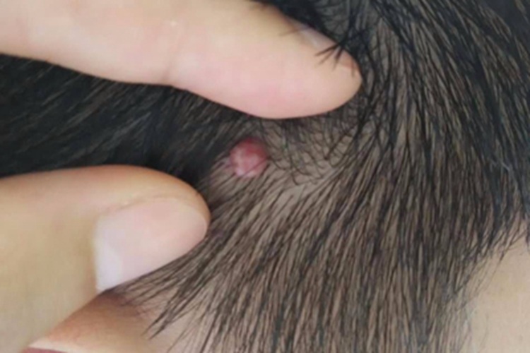 毛囊上皮瘤头皮结节图