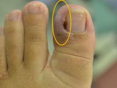 嵌甲大脚趾甲边缘红肿结血痂图.jpg