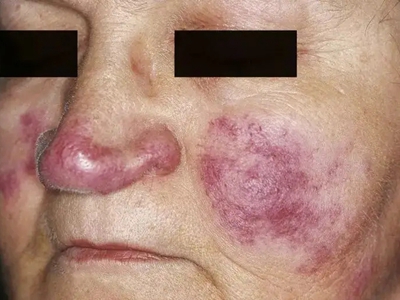 冻疮样红斑狼疮脸颊上有红斑图