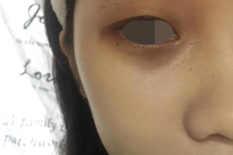 眶周黑变眼睛周围很黑图 眶周黑变眼睛周围很黑图