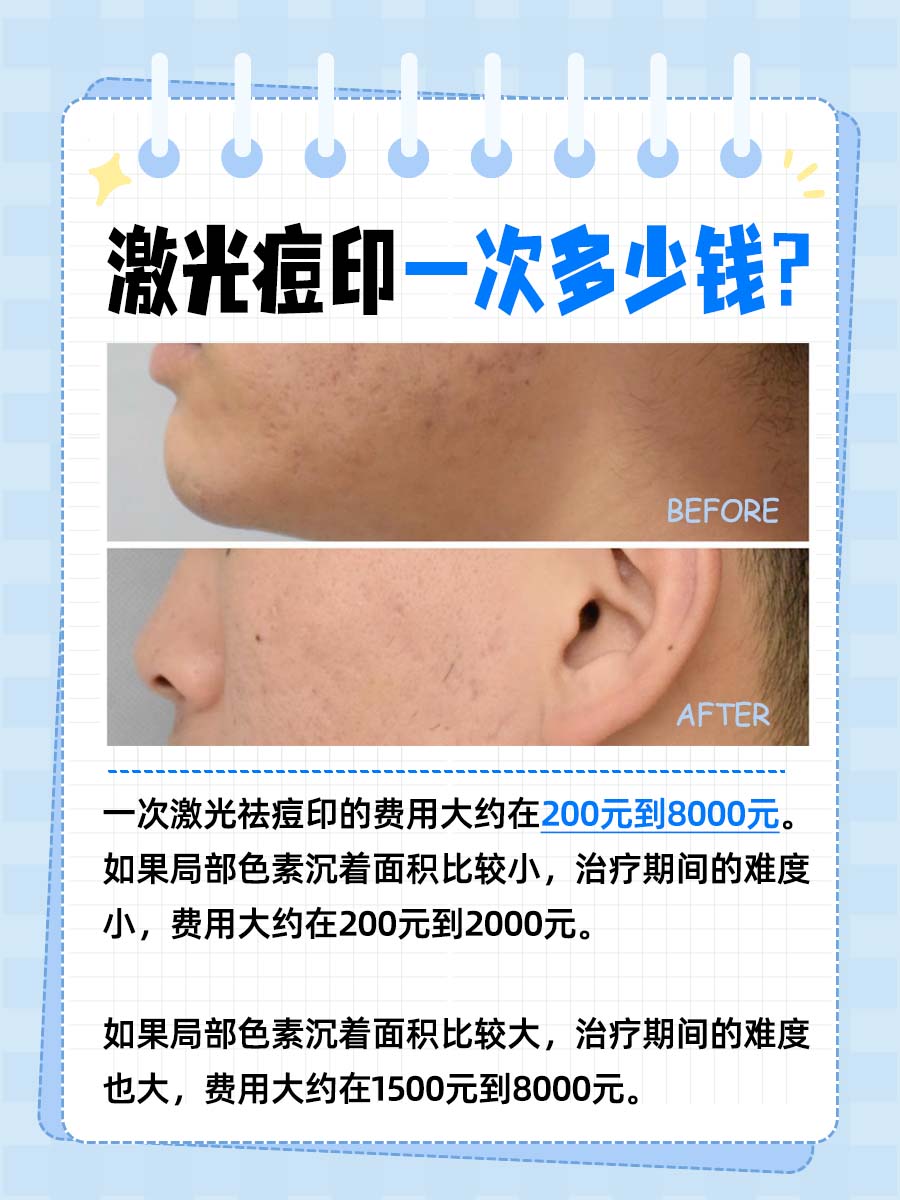 激光痘印一次多少钱？价格指南