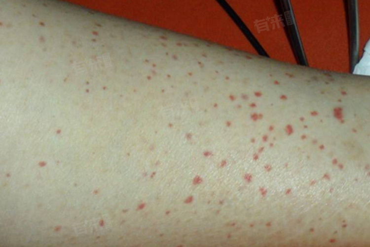 一招判断艾滋病小红点