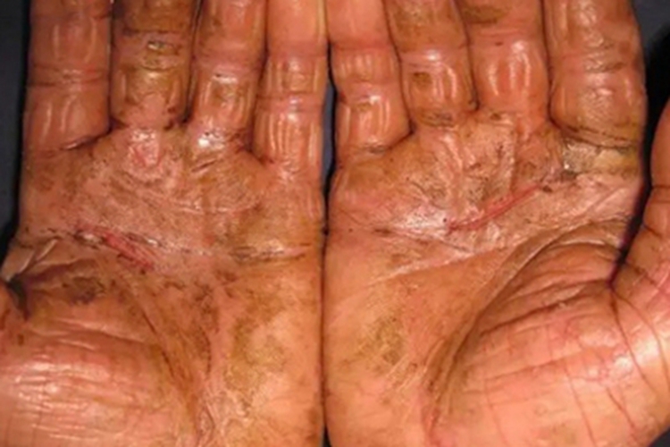 慢性接触性皮炎手掌斑图 慢性接触性皮炎手掌斑图