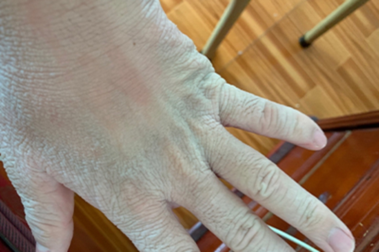 窝状角质松解症症状图 窝状角质松解症症状图