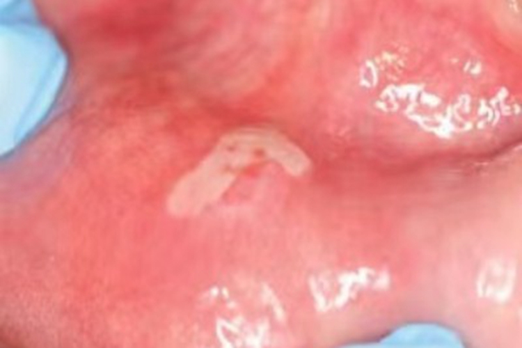 药物过敏性口炎口腔溃疡图 药物过敏性口炎口腔溃疡图