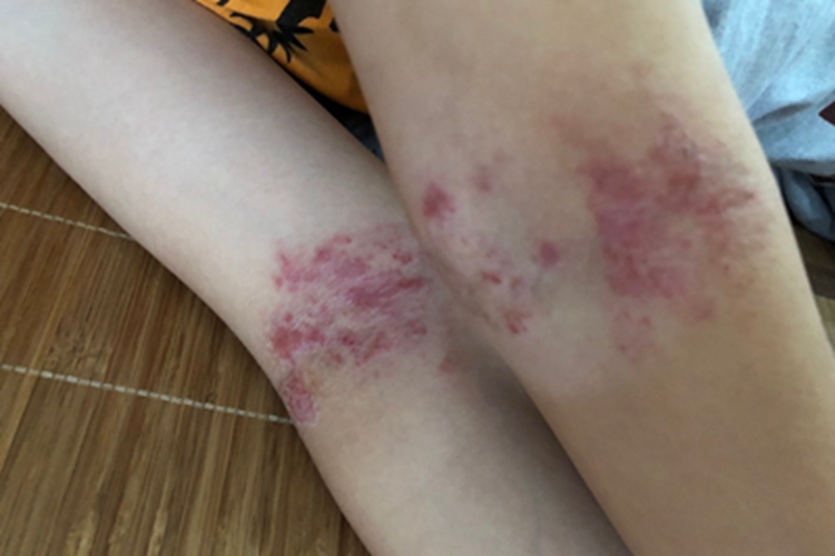 急性湿疹胳膊肘窝有多个红疙瘩图