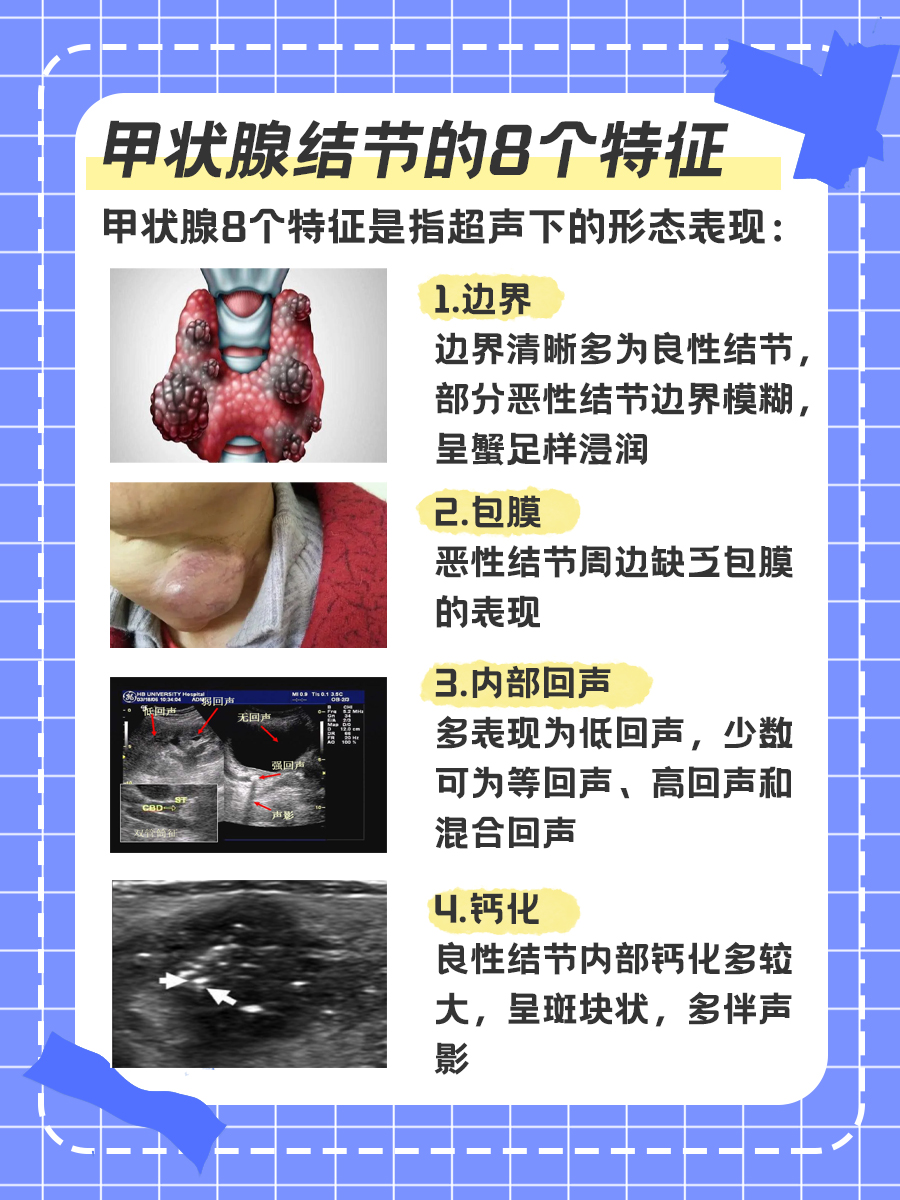 带你了解：甲状腺结节的8个特征，真嘟假嘟？