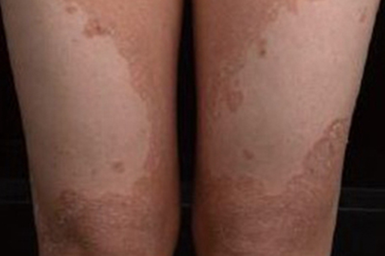 非大疱性鱼鳞病样红皮病白斑图 非大疱性鱼鳞病样红皮病白斑图