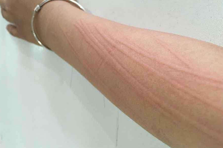 手臂皮肤划痕症图 手臂皮肤划痕症图