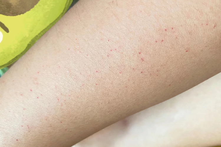 胳膊过敏性紫癜图