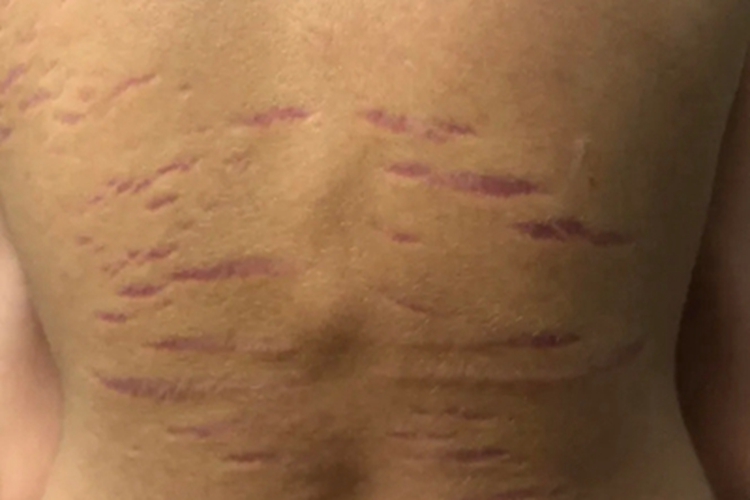 萎缩纹背部凹陷性红色条纹图