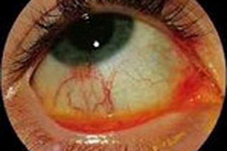 红眼病初期症状图 红眼病初期症状图