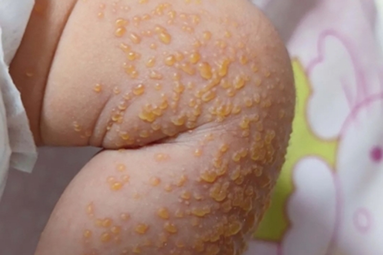 脓疱疮水疱图 脓疱疮水疱图