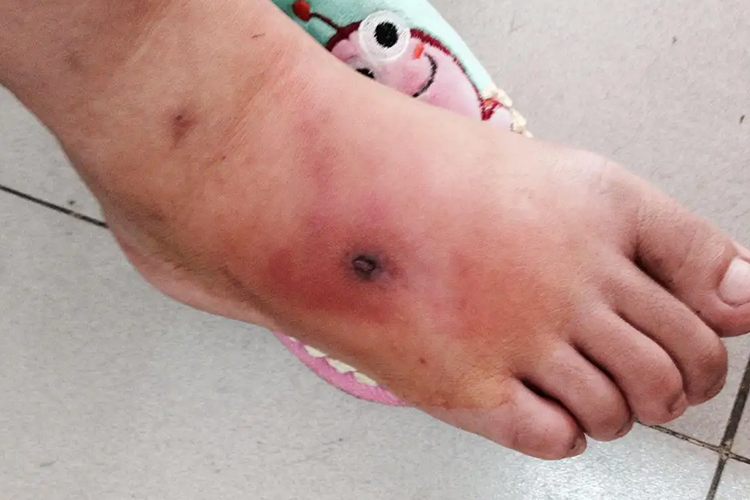 丹毒脚上水肿性红斑图