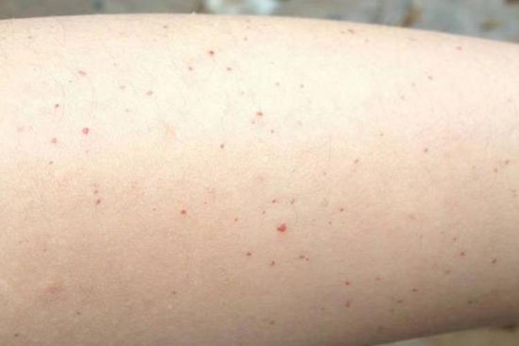 肝癌晚期皮下出血图