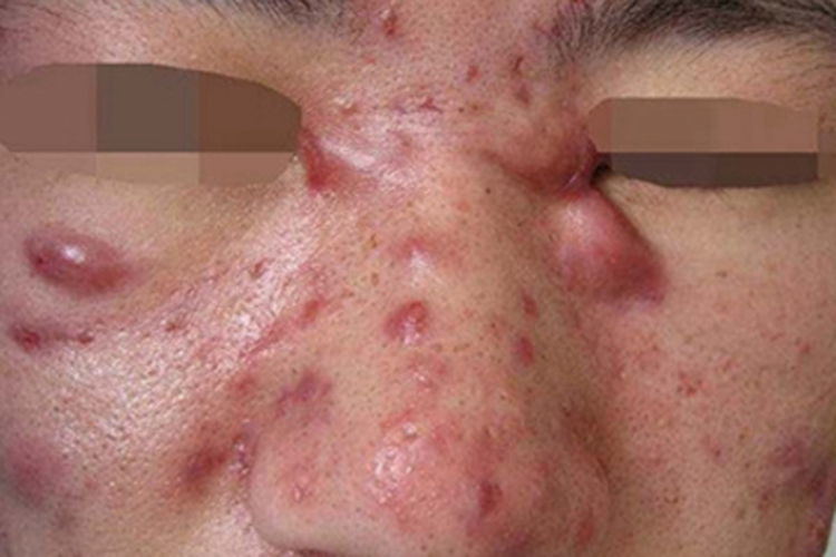 聚合性痤疮面部囊肿图