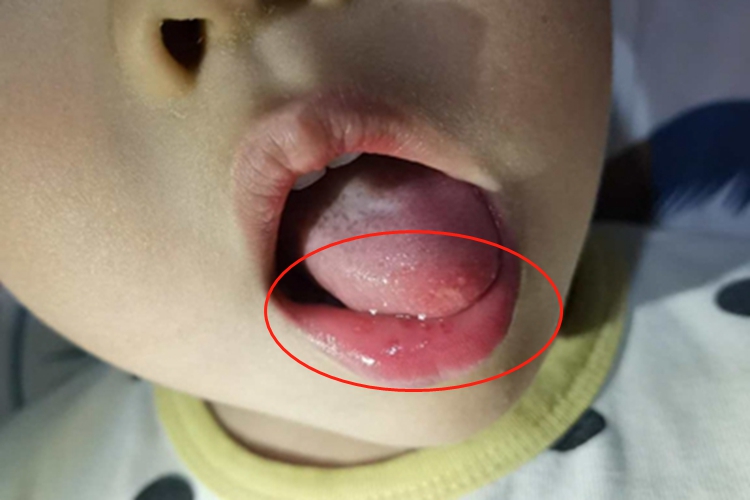 小儿口炎口腔糜烂图
